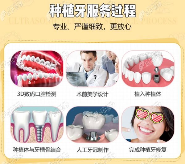暨南雅皓口腔种植牙过程