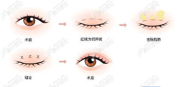 双眼皮组织粘连的症状