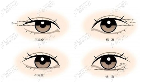 三点双眼皮黏连的原因