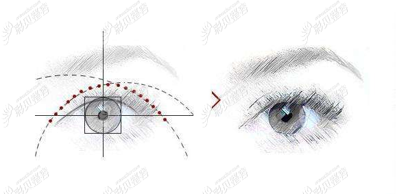 三点双眼皮粘连的剥离时间