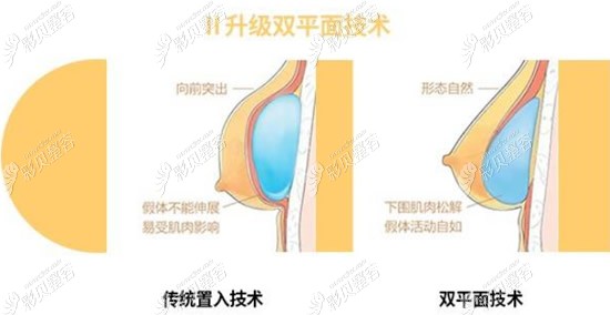 传统植入技术和双平面技术的区别