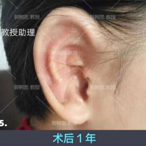 郭树忠再造耳图片:做完二期小耳畸形矫正后耳朵悄悄长出来!