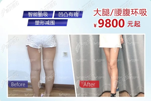 ​广州韩妃吸脂瘦大腿价格送达!还有大腿抽脂后瘦15cm的效果