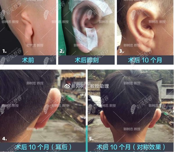 西安郭树忠医生再造耳10个月后两边耳朵是对称的