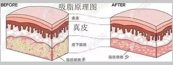 吸脂原理图