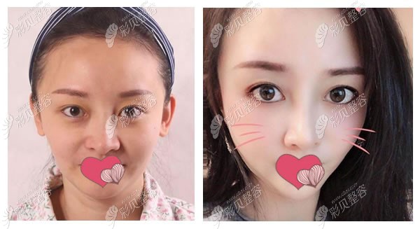 美国极限音波提拉全脸的案例效果图