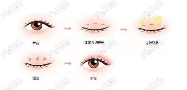 王赞医生做切开双眼皮的五大优势