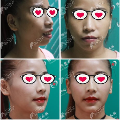 <i data-id=10f46e0c-3682-4617-9fa3-d65748b8bb34></i>正颌手术效果怎么样