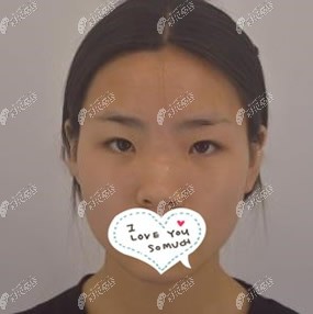 去无锡坤如玛丽医院做全切双眼皮前的样子