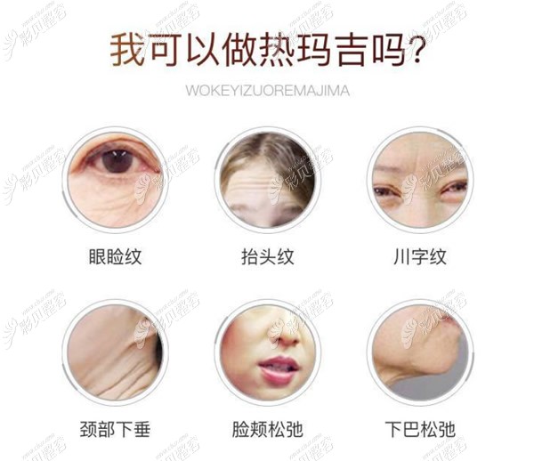热玛吉可以消除哪些皱纹