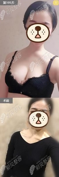 去汕头华美做曼托假体隆胸术前术后对比图 去汕头华美做曼托假体隆胸术前术后对比图