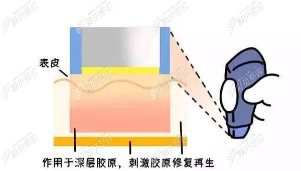 热玛吉有没有后遗症，到底会不会老的更快