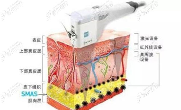 热玛吉除皱的费用是多少