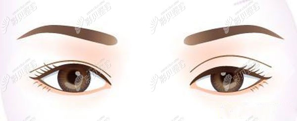 王立刚医生做双眼皮失败的技术优势