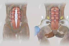 瞧!广州中家医家庭医生的腹壁成型手术费用和前后恢复图片