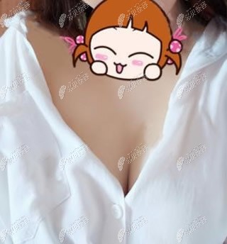 泉州欧菲刘伟峰傲诺拉假体隆胸一个月效果图