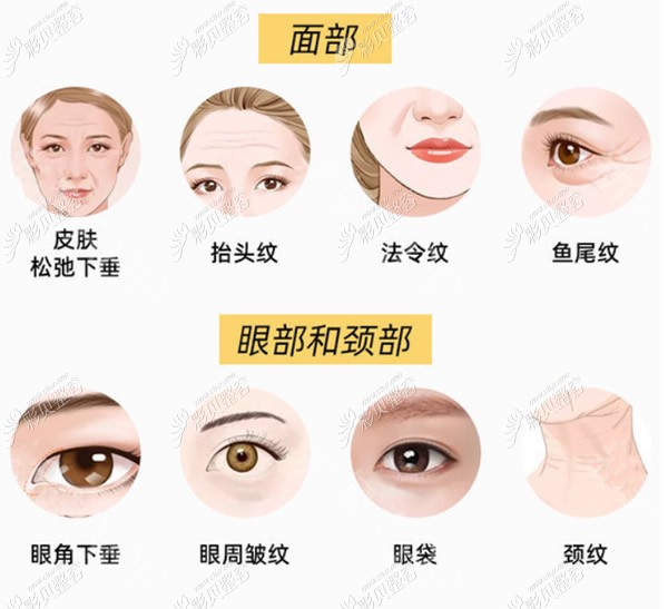 热玛吉可以解决哪些面部问题