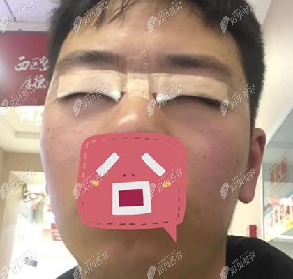 成都西区医院颜子云全切双眼皮术后第1天