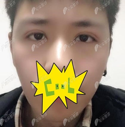 成都西区颜子云双眼皮10天效果图