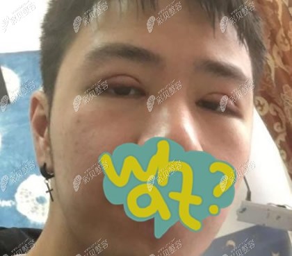 成都西区医院颜子云医生切开双眼皮第3天