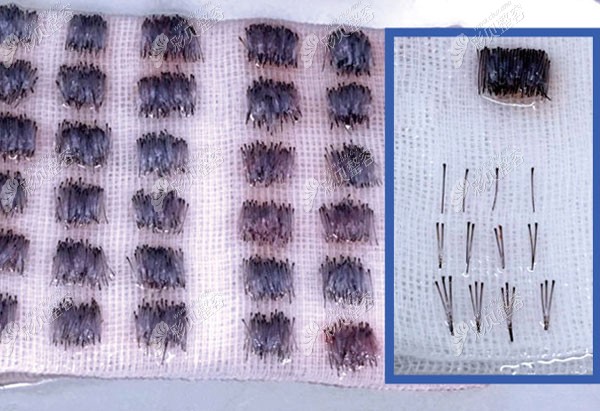 在济南名韩做发际线种植时，提取的毛囊