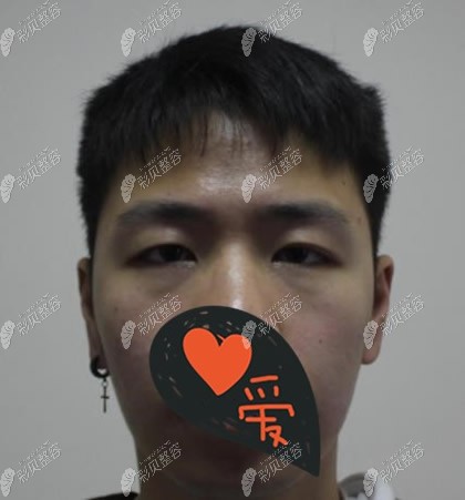 成都西区医院颜子云双眼皮术前照