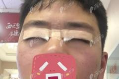 成都西区医院颜子云双眼皮案例：男人割双眼皮也很帅！