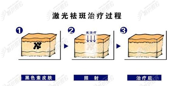 黄俊杰医生做激光祛斑的技术优势 黄俊杰医生做激光祛斑的技术优势