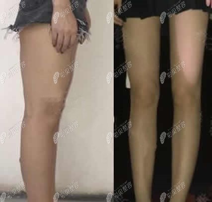 济南海峡整形徐永大腿吸脂前后对比照片 济南海峡整形徐永大腿吸脂前后对比照片