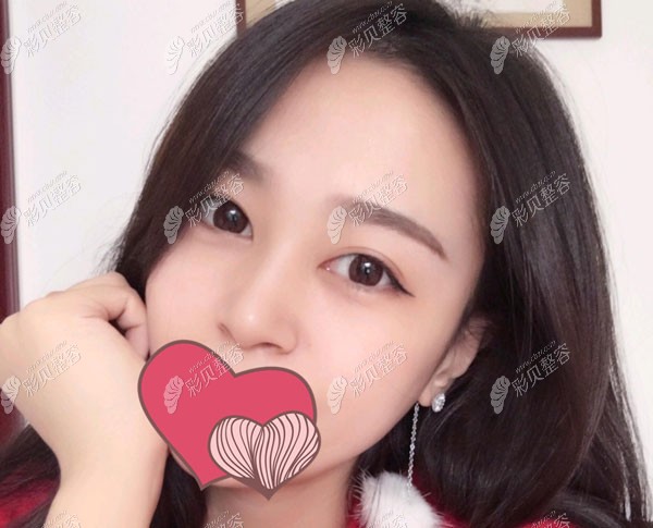 做韩国美迪塑埋线提升一个月基本上没有手术痕迹