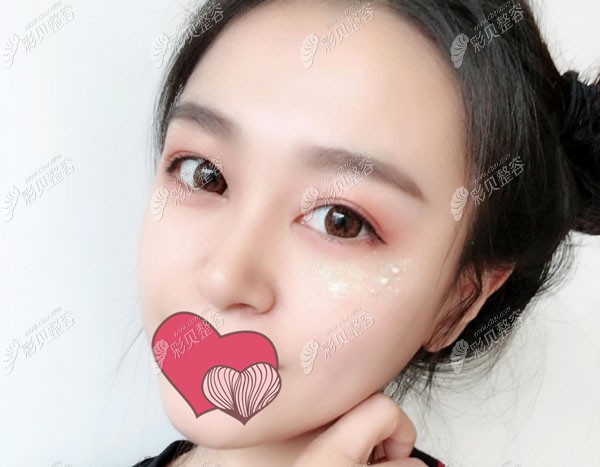 埋线提升3个月皮肤很有弹性