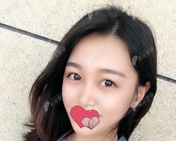 在北京美易美时代整形做埋线提升3年后的效果