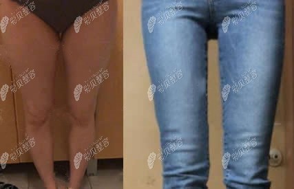 济南韩氏郭广科大腿吸脂效果图 济南韩氏郭广科大腿吸脂效果图