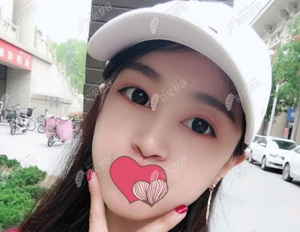 找北京张海医生做埋线提升2个月的效果