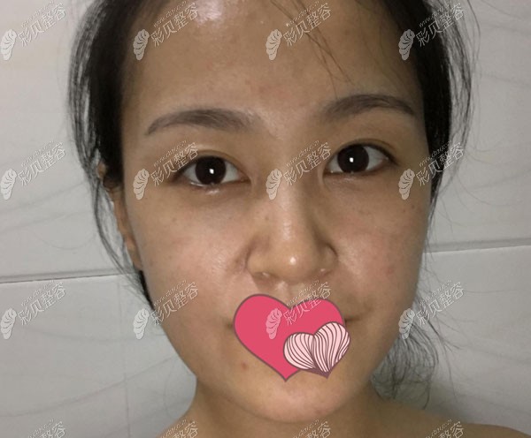 面部做埋线提升前