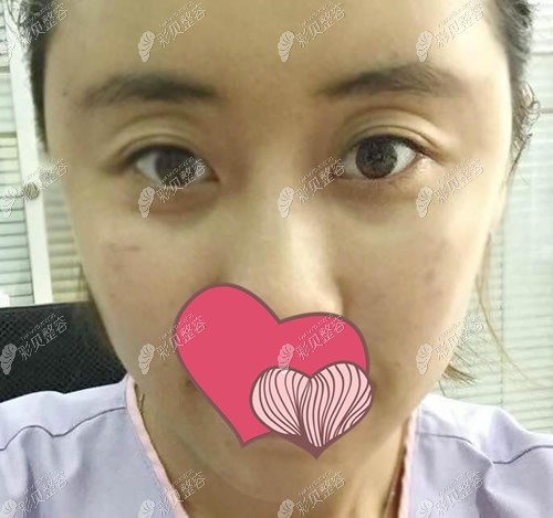 臻美整形全脸脂肪填充第1天