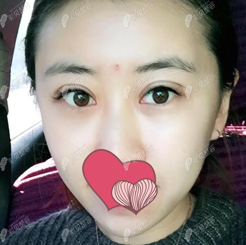 臻美整形脂肪填充面部第10天