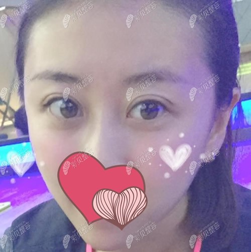 哈尔滨全面部脂肪填充第20天