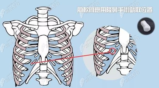 肋软骨隆鼻图片