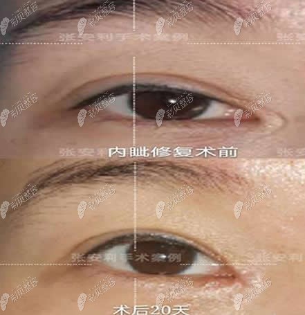张安利医生内眦修复前后对比照片