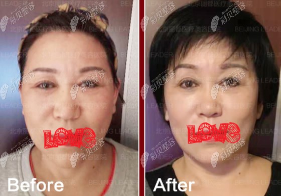 老妈56岁,在北京丽都做smas面部双平面提升除皱后像40岁！