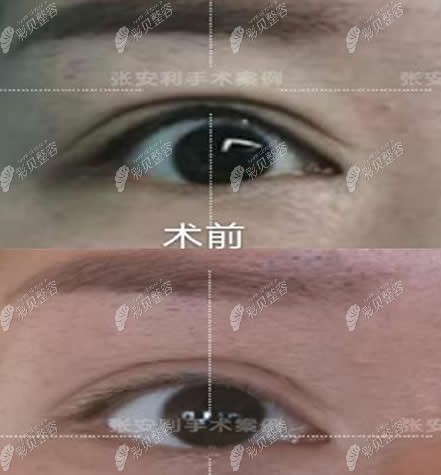张安利医生内眦修复前后对比照片