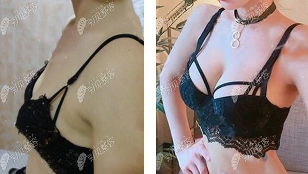 昆明韩辰王德宁医生svf脂肪胶丰胸案例