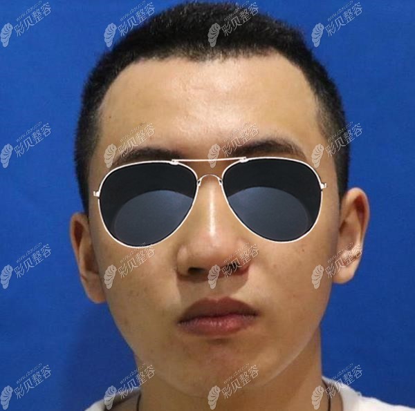 武汉亚韩医院邓正辉做鼻子案例:医生选对了,大叔也能变鲜肉