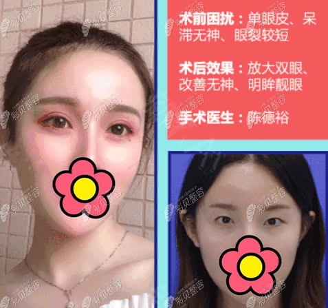 温州星范整形陈德裕院长全切双眼皮案例