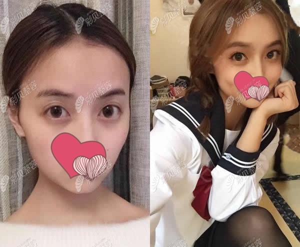 兰州韩美自体脂肪填充脸部术前术后对比照