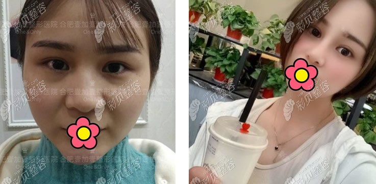 合肥壹加壹王大勇肋软骨隆鼻效果怎么样