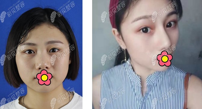 崔向葵医生进口假体隆鼻+耳软骨鼻尖成形效果图