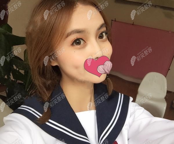 兰州韩美面部脂肪填充术后照