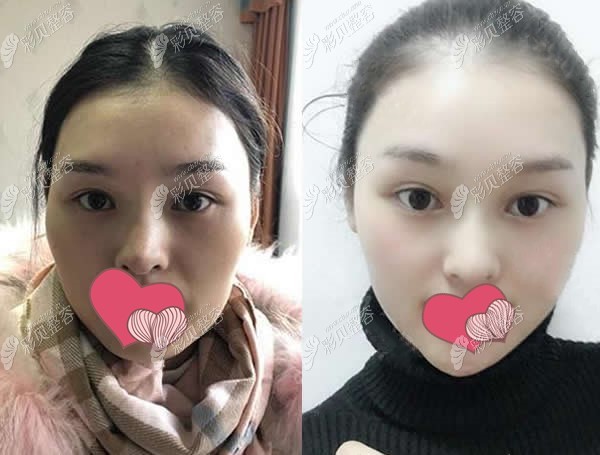 长沙贝美熊宜文医生歪鼻矫正术前术后对比图